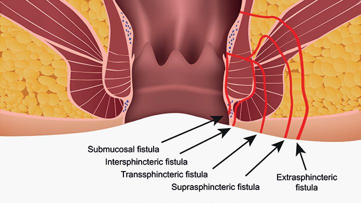 fistula doctor in kolkata