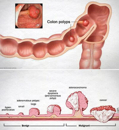 colorectal-cancer-400x438