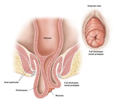 figure3b_prolapse-full-final-400x366