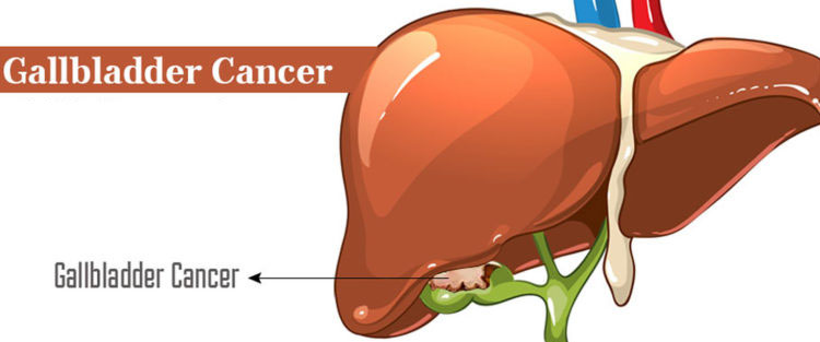 gallbladder cancer surgeon in kolkata