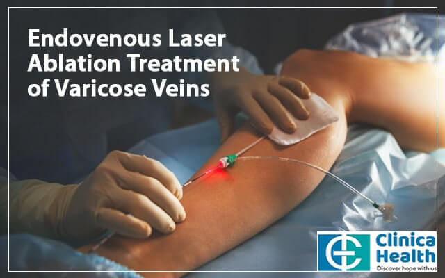 Endovenous Laser Ablation Treatment of Varicose Veins