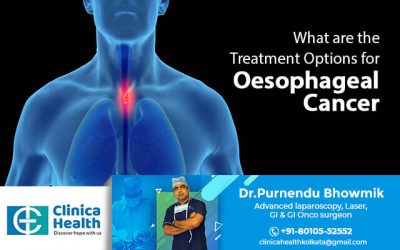What are the Treatment Options for Oesophageal Cancer