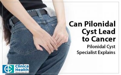 Can Pilonidal Cyst Lead to Cancer: Pilonidal Cyst Specialist Explains