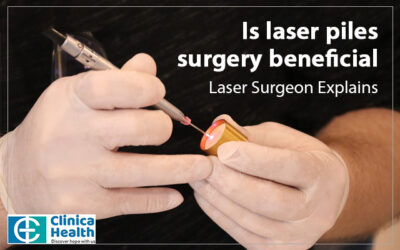 Is laser piles surgery beneficial: Laser Surgeon Explains