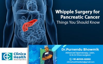 Whipple Surgery for Pancreatic Cancer – Things You Should Know