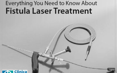 Everything You Need to Know About Fistula Laser Treatment