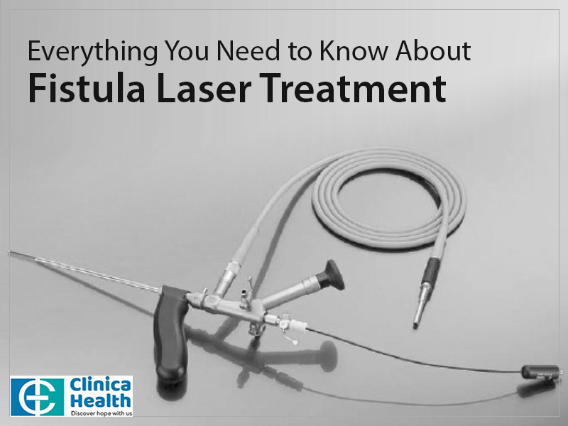 Everything You Need to Know About Fistula Laser Treatment