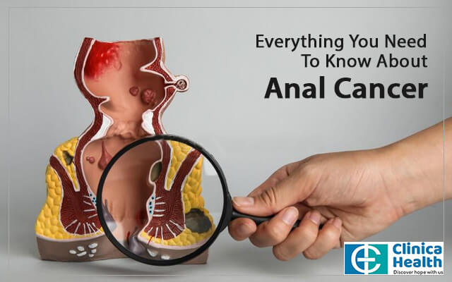 Everything You Need To Know About Anal Cancer