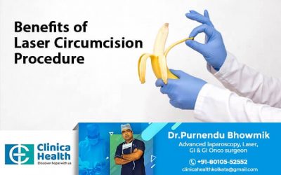 Benefits of Laser Circumcision Surgery