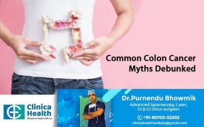 Common Colon Cancer Myths Debunked