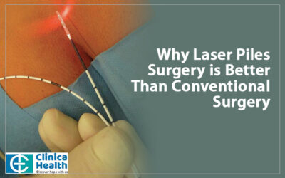 Why Laser Piles Surgery is Better Than Conventional Surgery?