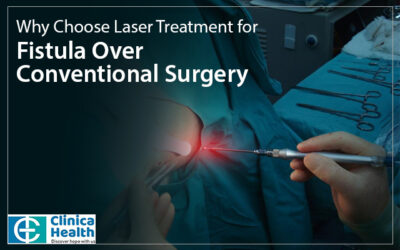 Why Choose Laser Treatment For Fistula Over Conventional Surgery?