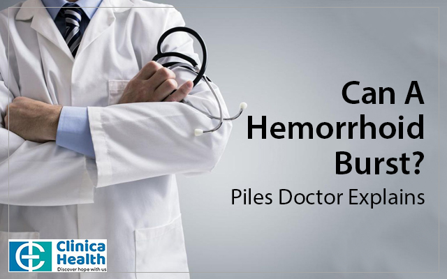 Can A Hemorrhoid Burst Piles Doctor Explains