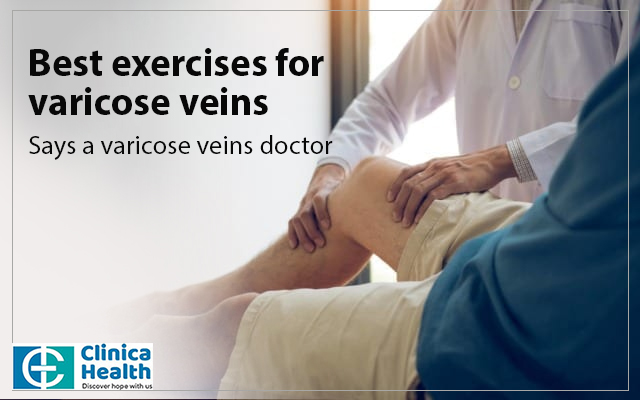 Best exercises for varicose veins
