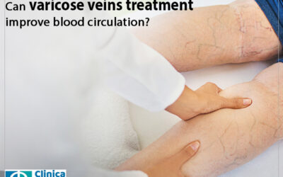 How can varicose veins affect your blood circulation?
