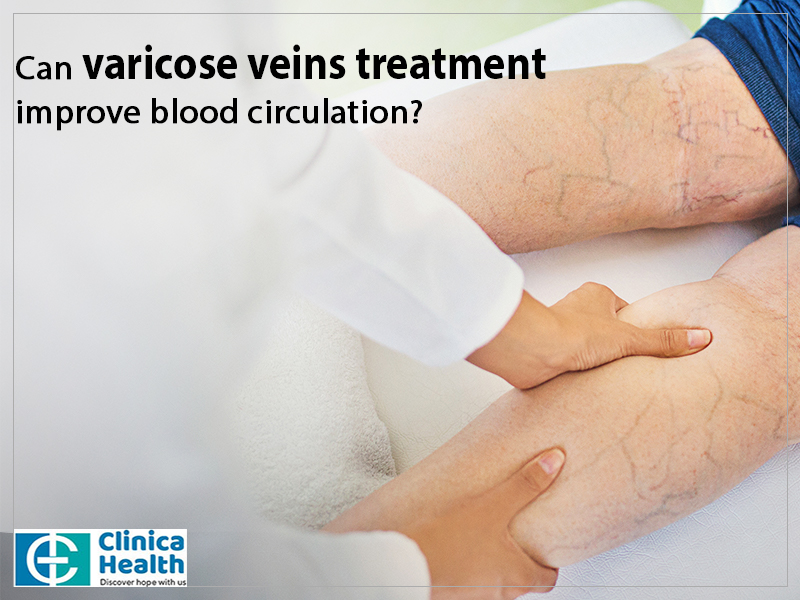 How can varicose veins affect your blood circulation?