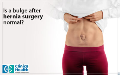 Is a bulge after hernia surgery normal?