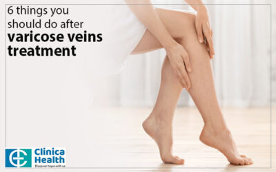 7 things you should do after varicose veins treatment