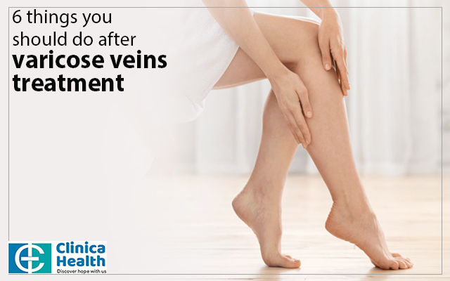 7 things you should do after varicose veins treatment