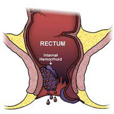 Bleeding per rectum
