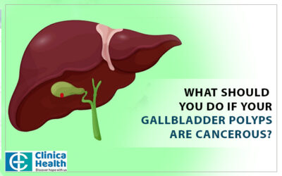 What should you do if your gallbladder polyps are cancerous?