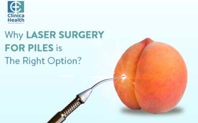 Why Laser Surgery for Piles Is The Right Option?