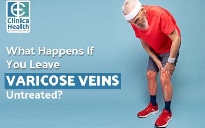 What Happens If You Leave Varicose Veins Untreated?