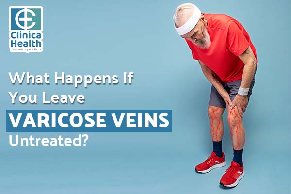 What Happens If You Leave Varicose Veins Untreated?