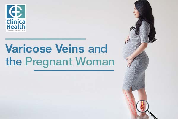 Varicose Veins and the Pregnant Woman