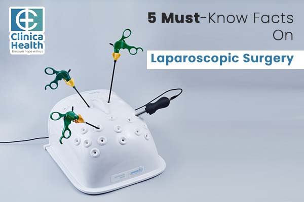 5 Must-Know Facts On Laparoscopic Surgery