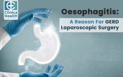 Oesophagitis: A Reason For GERD Laparoscopic Surgery