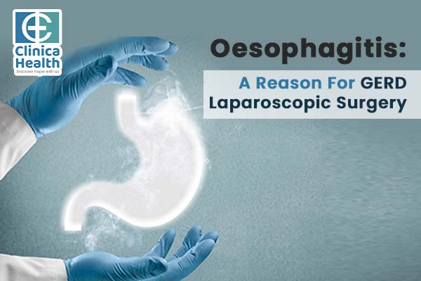 GERD Laparoscopic Surgery