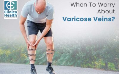 When To Worry About Varicose Veins?