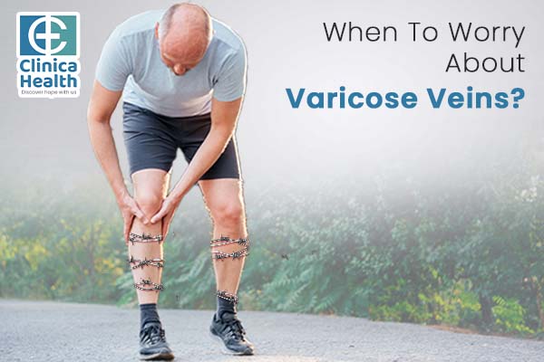 When To Worry About Varicose Veins?