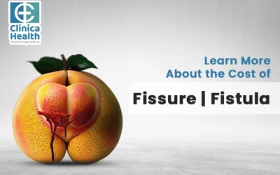 Learn More About the Cost of Fissure Fistula