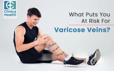 What Puts You At Risk For Varicose Veins?