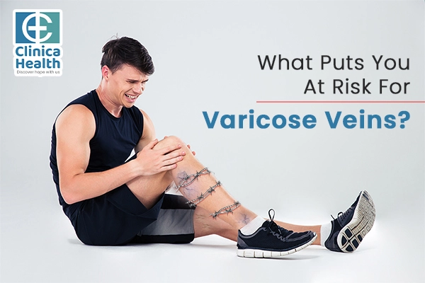 What Puts You At Risk For Varicose Veins?