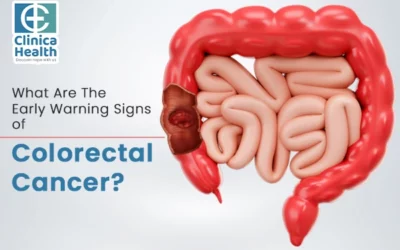 What Are The Early Warning Signs of Colorectal Cancer?