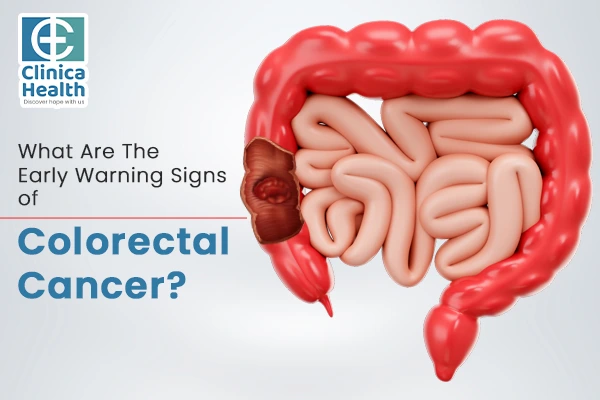 What Are The Early Warning Signs of Colorectal Cancer?