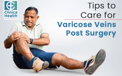 Tips to Care for Varicose Veins Post-Surgery 