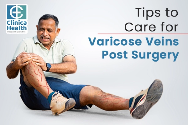 Tips to Care for Varicose Veins Post-Surgery 