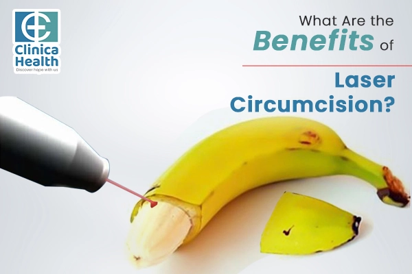 What Are the Benefits of Laser Circumcision?