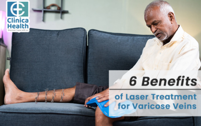 6 Benefits of Laser Treatment for Varicose Veins