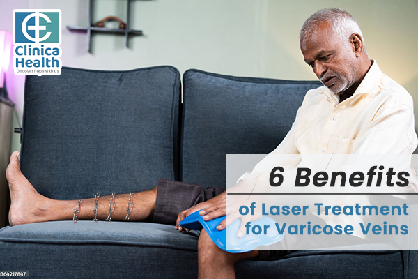 6 Benefits of Laser Treatment for Varicose Veins