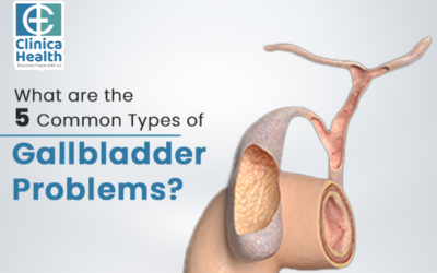 What are the 5 Common Types of Gallbladder Problems?