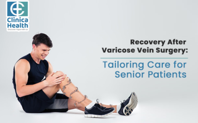 Recovery After Varicose Vein Surgery: Healing Guidance