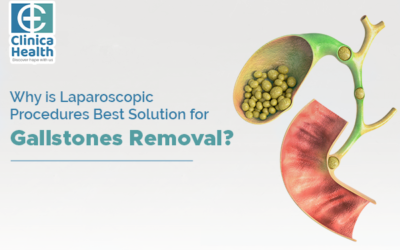 Why is Laparoscopic Procedures the Best Solution for Gallstones Removal?