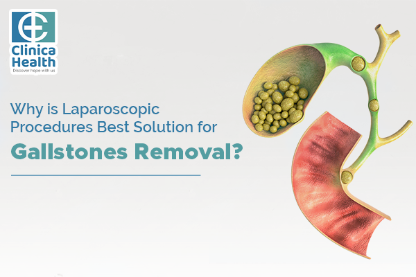 Why is Laparoscopic Procedures the Best Solution for Gallstones Removal?