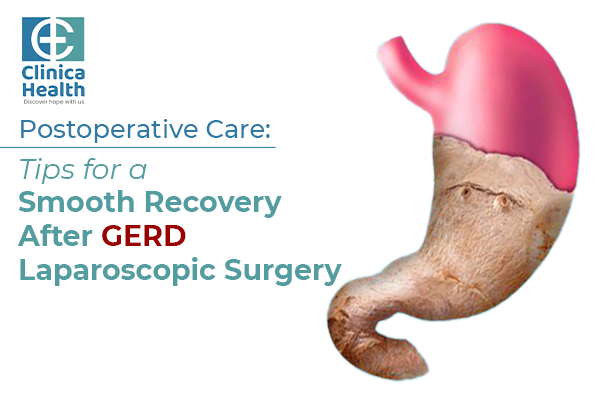 Postoperative Care: Tips for a Smooth Recovery After GERD Laparoscopic Surgery