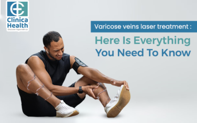 Varicose Veins Laser Treatment: Here is Everything You Need To Know